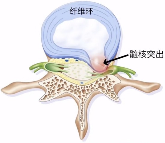 舒筋健腰丸教你三招预防腰部不适